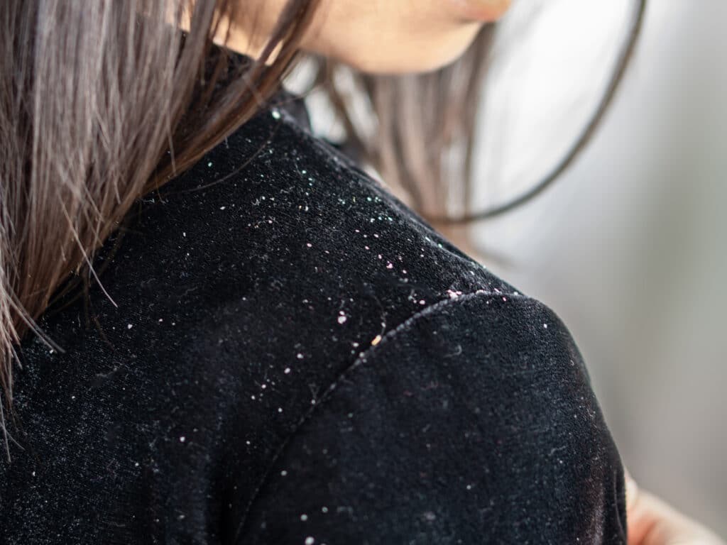 Immagine di una ragazza e si vede che sulla sua spalla ci sono delle scaglie di pelle causate dalla forfora.