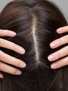 Image of a girl showing her scalp.