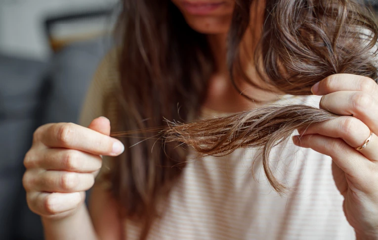 young woman has hair loss problem loosing hair